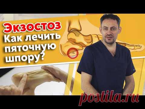 Почему болит пятка? | Экзостоз пяточной кости | Массаж при пяточной шпоре