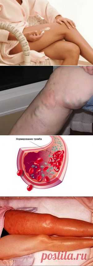 Тромбофлебит чешется