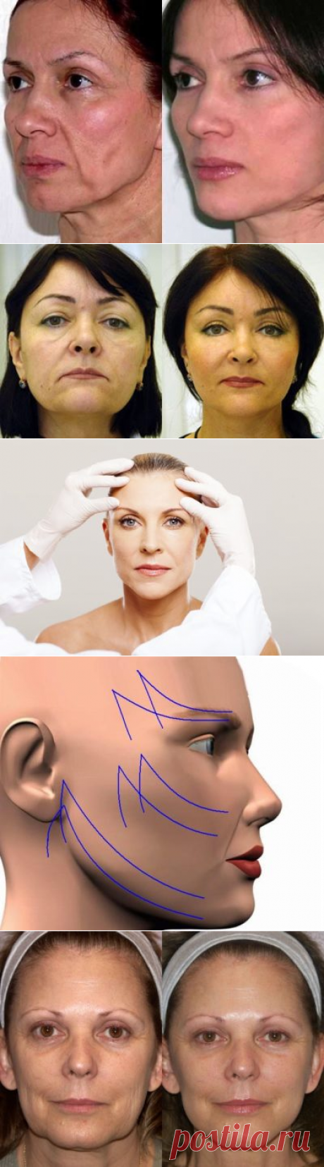 Подтяжка лица хирургическим путем, цена