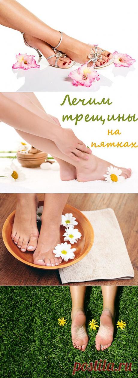 Лечение трещин на пятках | Сплетница