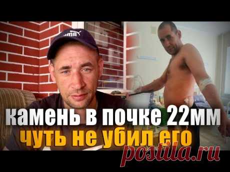 Могильщик чуть не умер от камня в почке 22мм! СПАСАЮ ДРУГА!