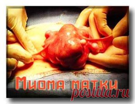Миома матки лечение народными средствами. Простые рецепты
