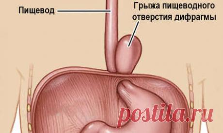 Операция ГПОД (грыжа пищевода): как проводится, реабилитационный период