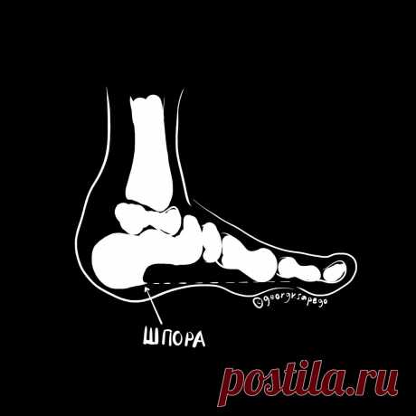 Пяточная шпора - Интернет ежедневник - медиаплатформа МирТесен