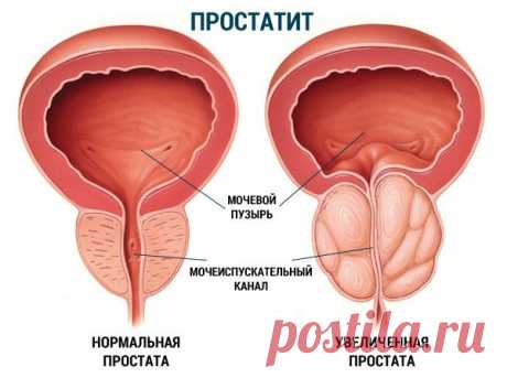ПРОВЕРЬ СЕБЯ! ПРЕДВЕСТНИКИ ПРОСТАТИТА:

Раз в год/полгода ощущали потягивание в области паха Иногда чувствуете покалывание, давление в промежности Заметили, что ходите в туалет чаще Наблюдаете, что одно яичко висит ниже другого Периодически мучаетесь запорами или поносом Видите, что эрекция стала слабее Снизилось сексуальное влечение Хоть раз испытывали сложность с мочеиспусканием