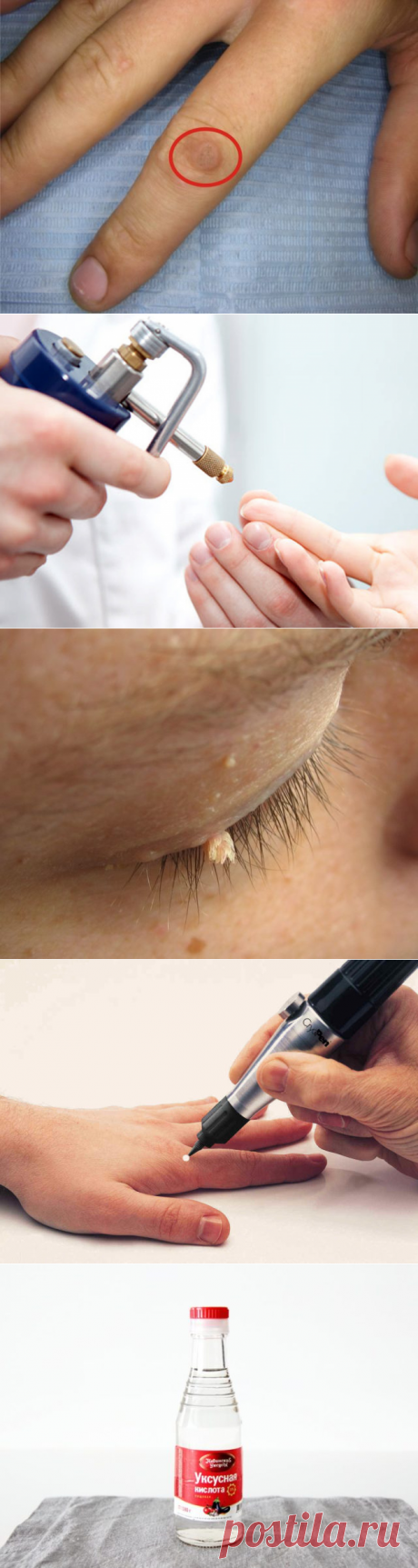 Прижигание азотом бородавок в домашних условиях, отзывы