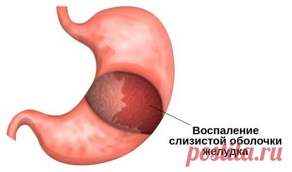 Гастрит острый: причины, симптомы и лечение в статье эндоскописта Ситало И. Ю.