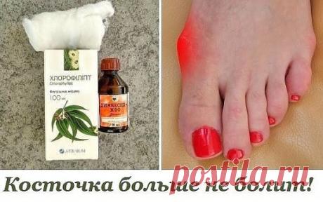 Косточка больше не болит! Потратила мелкие деньги на 2 средства, эффект невероятен!
Делюсь рецептом от операционной медсестры!