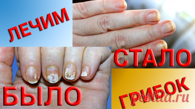 Лечение грибка ногтей народными средствами – самые ...


Понять, что требуется лечение грибка ногтей на руках народными средствами и самые ... Можно ли вылечить грибок ногтя народными средствами?