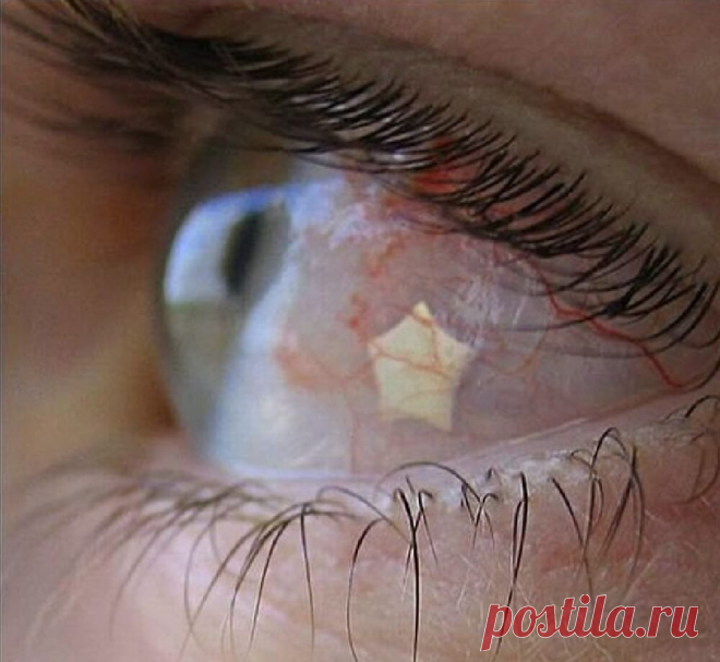 Шокирующий тренд: пирсинг глазных яблок