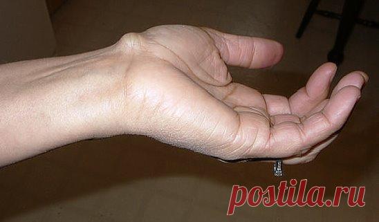 ЛЕГКО УБИРАЕМ НАРОСТЫ НА ПАЛЬЦАХ РУК И НОГ!!!
У меня в районе суставов появились наросты и пальцы как бы скрючились... 
В общем, зрелище не из приятных. 
Увидела мои руки знакомая и обрадовала - не переживай, у меня были такие же, и я сама их вылечила. 
И она рассказала рецепт лечения. 
Я использовала его 10 раз, и все мои наросты исчезли. 
Оказывается, таким образом можно избавиться и от «косточек» на ногах.
А рецепт таков:
 
В 10-миллиграммовой бутылочке йода следует растворить пять таблеток