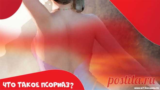 Что такое псориаз: причины, симптомы и лечение расстройства 

Среди заболеваний кожи одним из самых необычных считается псориаз.

Характерным признаком этой болезни являются красные пятна (папулы) на коже, над которыми образуются толстые и беловатые чешуйки.