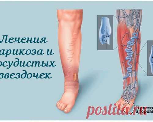 Несколько оригинальных народных рецептов лечения варикозного расширения вен и сосудистых "звездочек".