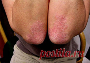 ЕСЛИ ТРЕВОЖИТ ПСОРИАЗ — ЭТА МАЗЬ, ДРУЗЬЯ, ДЛЯ ВАС