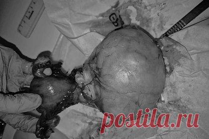 Опухоль размером с волейбольный мяч выросла в теле россиянки