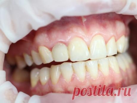 Пример профессиональной чистка и гигиена полости рта в стоматологии АлексДент