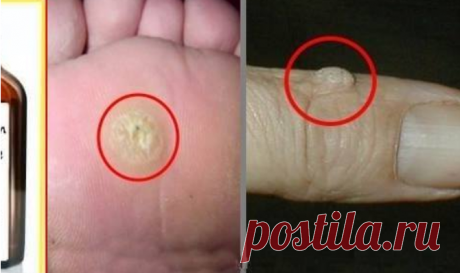 Как удалить бородавки и папиллому с помощью простого средства ~