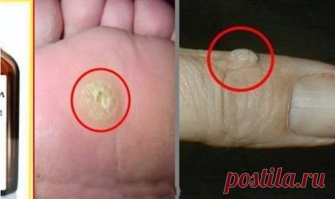 Как удалить бородавки и папиллому с помощью простого средства ~