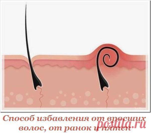 Способ избавления от вросших волос, от ранок и пятен, которые остаются после.