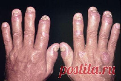 Артрит пальцев рук: причины, симптомы, лечение (фото)