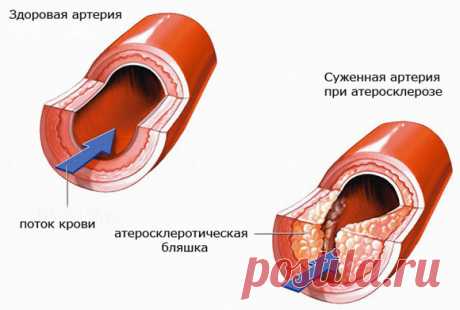 Наука. Kрупнейшая афера XX века !! Миф об опасности богатой холестерином пищи привел к серьезным последствиям для здоровья человечества. Раскрыты главные причины атеросклероза.