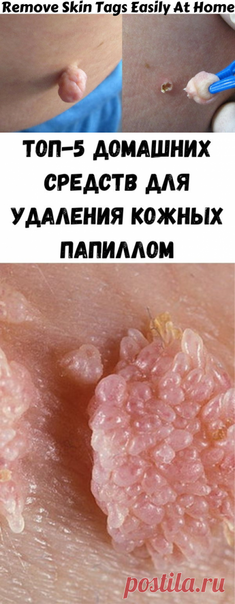 Топ-5 домашних средств для удаления кожных папиллом - Советы на каждый день