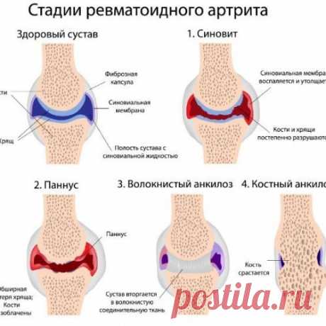 СУПЕРЛЕЧЕНИЕ - КАРТОФЕЛЬ НА КЕФИРЕ ПРОТИВ АРТРИТА