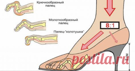 Вот что происходит с Вашим организмом, когда Вы перестаете носить высокие каблуки!