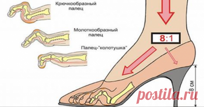 Вот что происходит с Вашим организмом, когда Вы перестаете носить высокие каблуки!