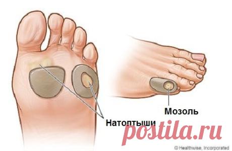 Как избавиться от мозолей легко и безболезненно? - Шаг к Здоровью