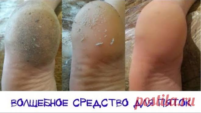 Волшебное средство для пяток. Моментальный эффект!