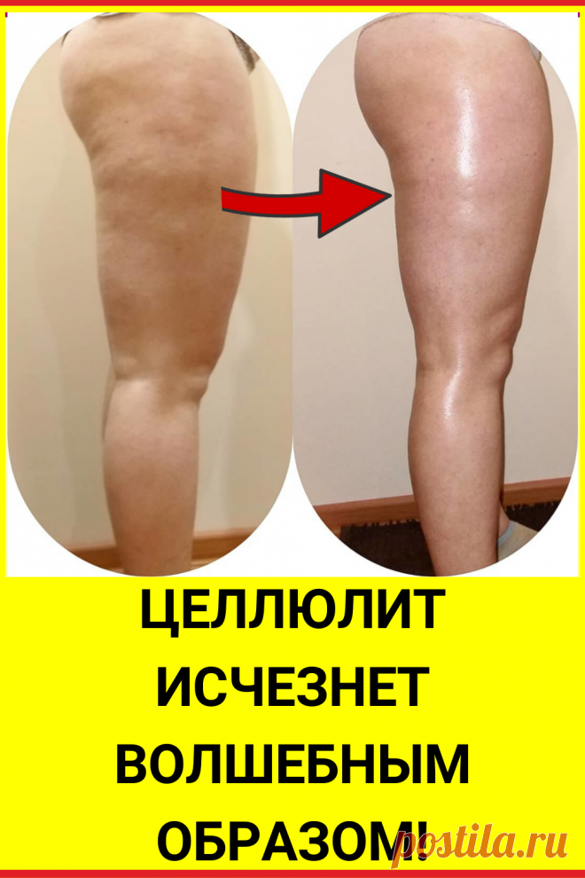 Целлюлит исчезнет волшебным образом!