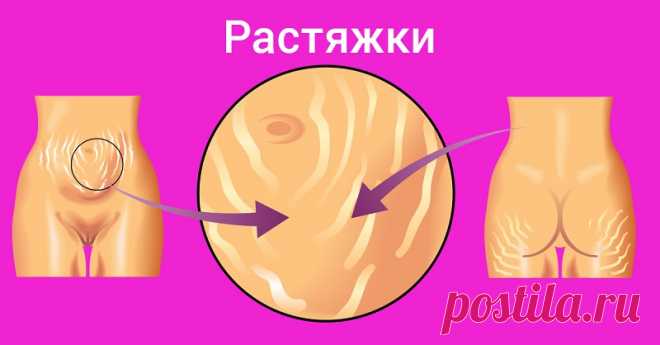 Куда делись растяжки? Копеечное средство из аптеки сделало кожу божественной! | KaifZona.Ru | Страница 2