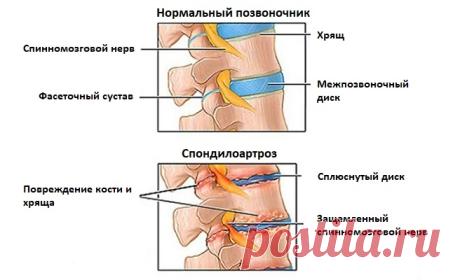 Спондилоартроз шейного отдела позвоночника: лечение, симптомы, признаки, спондилез