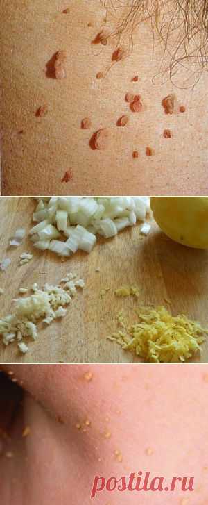 Лечение ВПЧ (вирус папилломы человека) в домашних условиях: | Советы Народной Мудрости