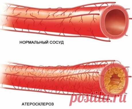 Борьба с атеросклерозом, холестерином, неэластичностью сосудов: 7 популярных рецептов со свеклой | ПРОДУКТЫ | Яндекс Дзен