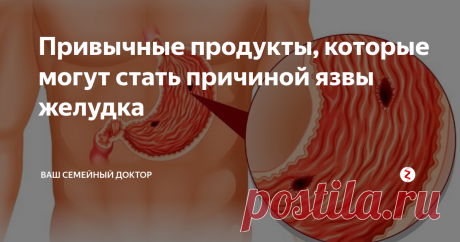 Привычные продукты, которые могут стать причиной язвы желудка Язва желудка – одно из распространенных заболеваний пищеварительной системы. Главной причиной патологии является инфекционный агент - бактерия хеликобактер пилори.
