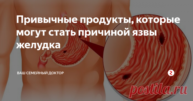 Привычные продукты, которые могут стать причиной язвы желудка Язва желудка – одно из распространенных заболеваний пищеварительной системы. Главной причиной патологии является инфекционный агент - бактерия хеликобактер пилори.