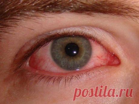 Конъюнктивит - симптомы и лечение у детей и взрослых