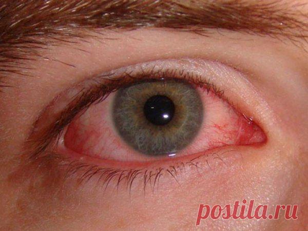 Конъюнктивит - симптомы и лечение у детей и взрослых