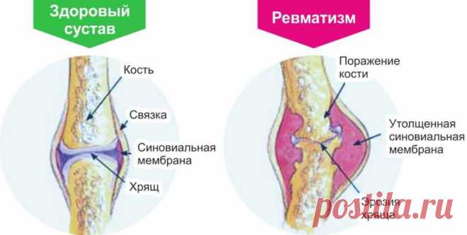Лечение ревматизма народными методами: спасительные травы придут на помощь