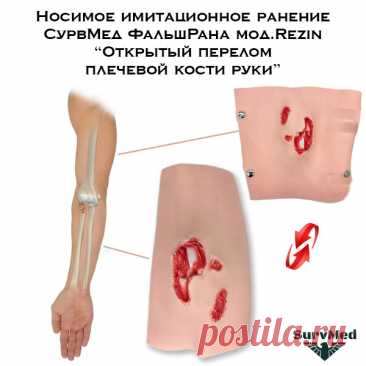 Открытый перелом руки: симптомы, диагностика и лечение
Что такое открытый перелом

Открытый перелом — это повреждение кости, при котором происходит разрыв кожных покровов и визуализация костных отломков в ране.
