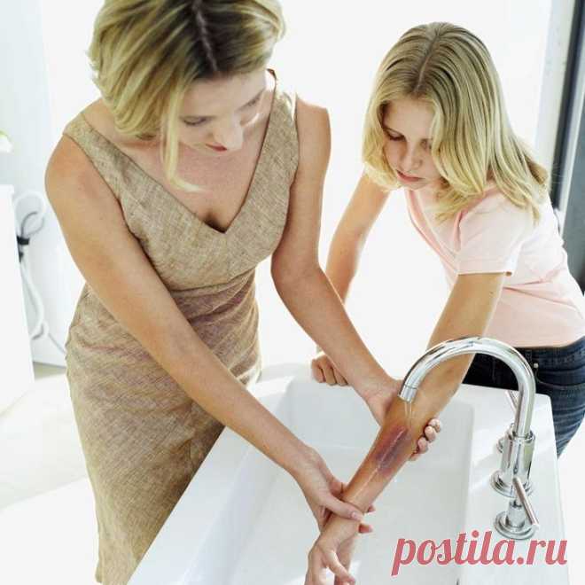 Первая помощь пострадавшему при ожогах