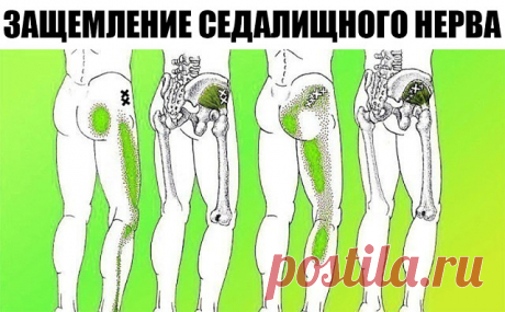 Если у тебя воспаление седалищного нерва, воспользуйся ЭТИМ средством для его лечения!

В последние годы от неврологических заболеваний страдает всё больше людей. Больные нередко жалуются на тянущие боли в спине, пояснице и области ягодиц. Неприятные ощущения могут опускаться к ногам. Ишиас — это очень неприятное заболевание, связанное с защемлением и воспалением седалищного нерва в пояснично-крестцовом отделе позвоночника. Некоторые врачи называют этот недуг пояснично-кре...