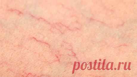 Природные средства от сосудистых звёздочек на ногах Если вам сильно досаждают эти фиолетово-красные узоры, попробуйте любой из предложенных способов лечения. Как показывает практика, регулярное применение обязательно приносит желаемый результат.Сосудис...