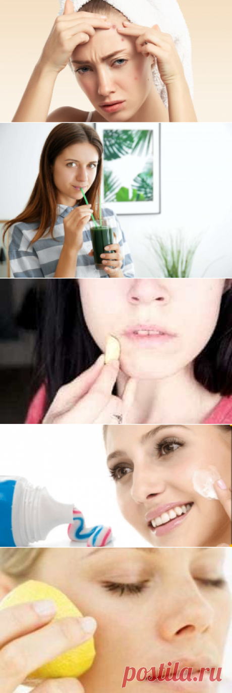 5 домашних средств от прыщей! Как быстро избавиться от прыщика?