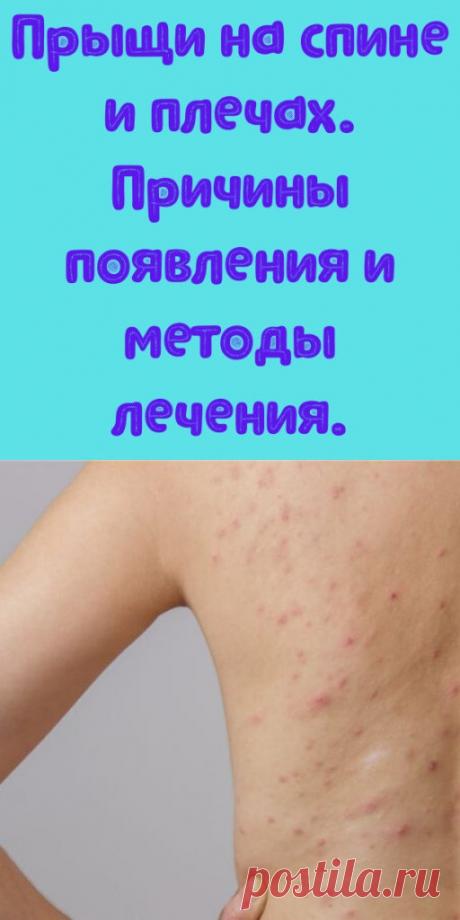 Прыщи на спине и плечах. Причины появления и методы лечения. - My izumrud