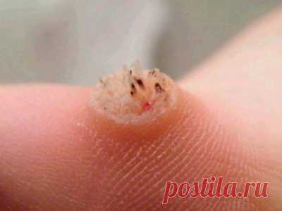 100 средство от бородавки Эффективные народные средства