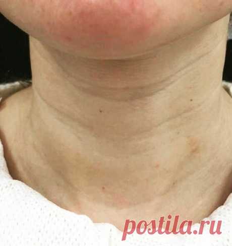 Как омолаживают шею и избавляются от &quot;кругов Венеры&quot; | beauty viewer | Яндекс Дзен