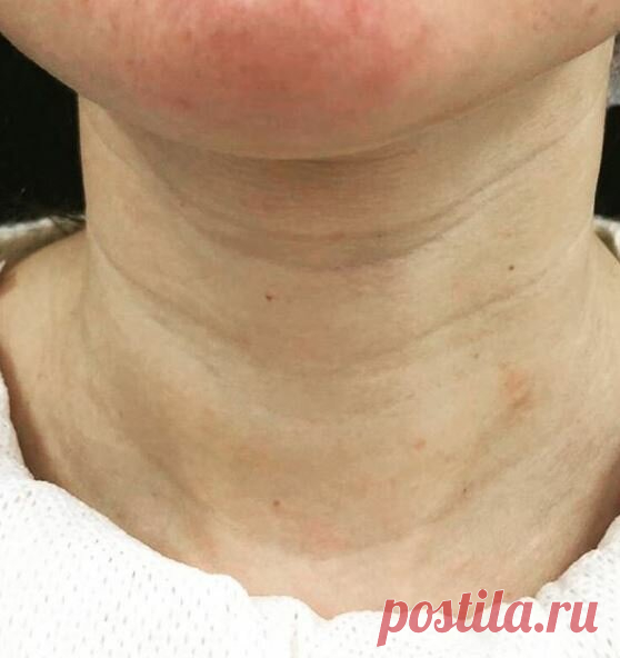 Как омолаживают шею и избавляются от 